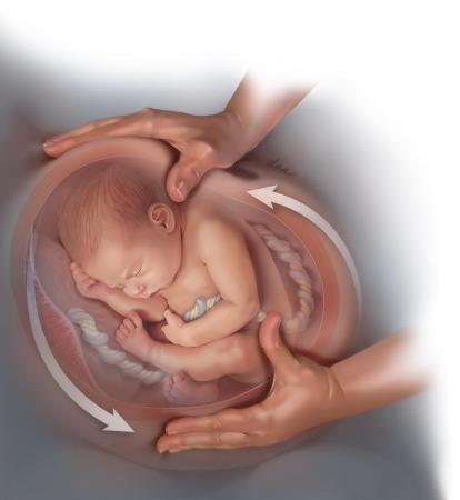 Versión podálica externa en Vigo