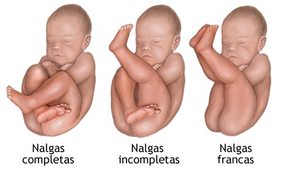 Variantes de presentaciones de nalgas o podálica