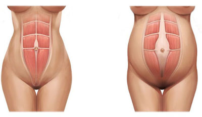 Diástasis abdominal. Consulta en Vigo. Cristina Valiñas